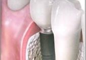Имплатны в стоматологии вытесняют протезы
